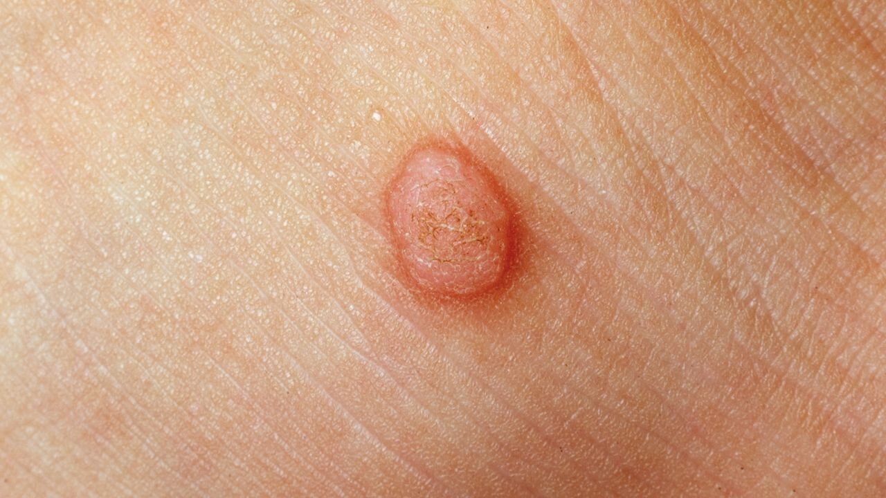 تفاوت خال گوشتی و زگیل چیست؟/ آیا کندن  زگیل با ناخنگیر یا بستن نخ خطرناک است؟
