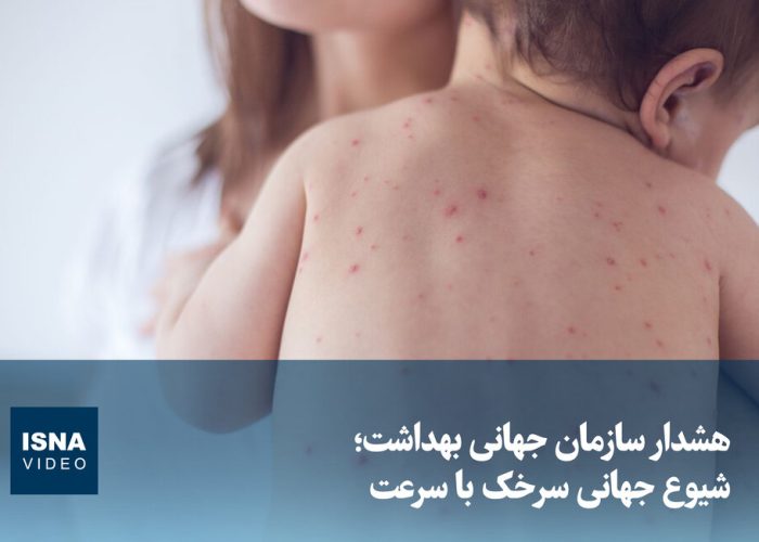ویدیو/ هشدار سازمان جهانی بهداشت؛ شیوع جهانی سرخک با سرعت