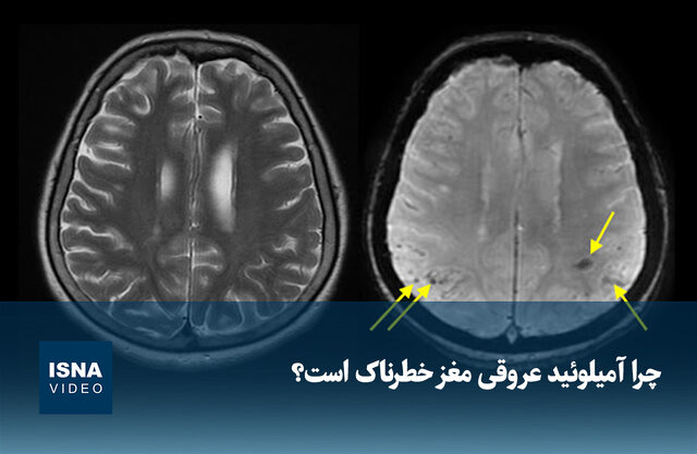 ویدیو/ چرا آمیلوئید عروقی مغز خطرناک است؟ ویدیو/ چرا آمیلوئید عروقی مغز خطرناک است؟
